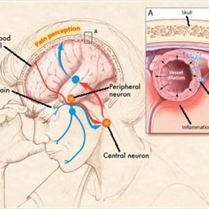 Secondary Headache - Migraines And Rebound Headaches