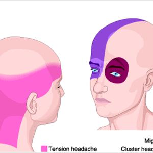 Severe Headache And Fever - How Do I Stop A Severe Migraine