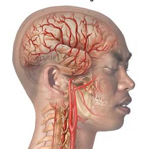 Vertiginous Migraine Patients - How To Deal With The Migraine Nausea Properly?