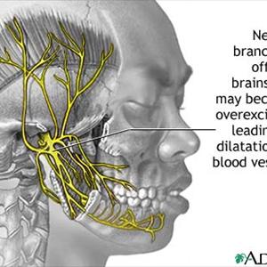 Botox For Migraines - Just Where You Should Look For Information About Migraines