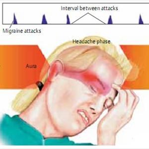 Migraine Vitamins And Minerals - Are The Causes Of Migraines Genetic In Nature