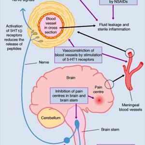 Migraine Ice Therapy - Aromatherapy As An Alternative Treatment For Migraine Headaches