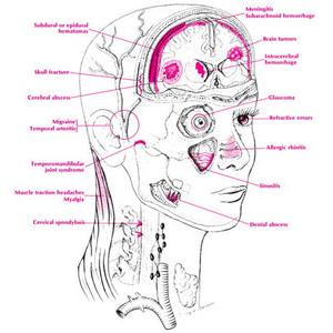 Latelife Migrainous Accompaniments - Ocular Migraine - Symptoms And Treatment