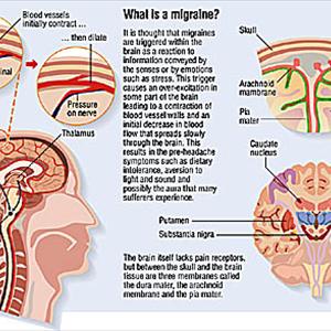 Acupuncture Migraine Relief - Causes Migraine Headaches