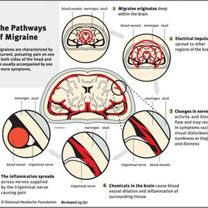 Advil Migraine Capsules - Headache Symptoms - How To Get Rid Of Headache